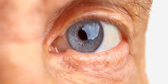 Cirurgia de catarata