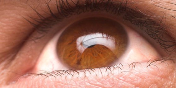 Cirurgia de  glaucoma